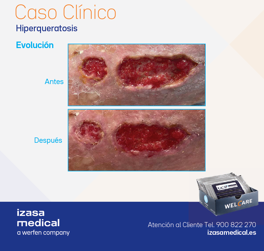 Caso Clínico de Hiperqueratosis